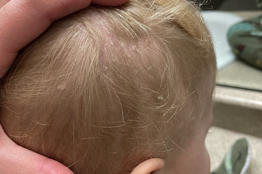 When the Rashes, Reflux, and Delays Don’t Make Sense: Katie’s Story of Finding the Root Cause | 161