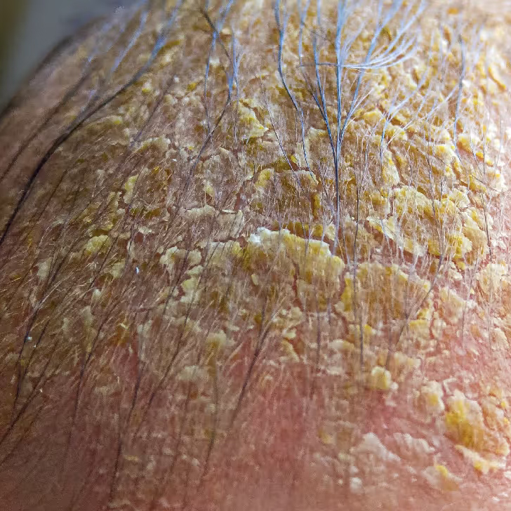 Scalp Healing Bundle