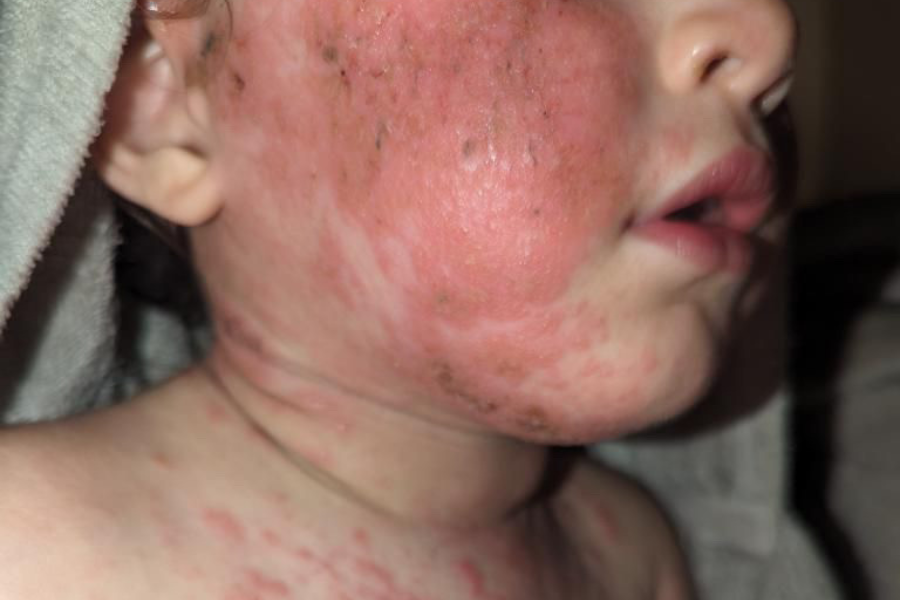 You Have to Know This to Heal Eczema | 102