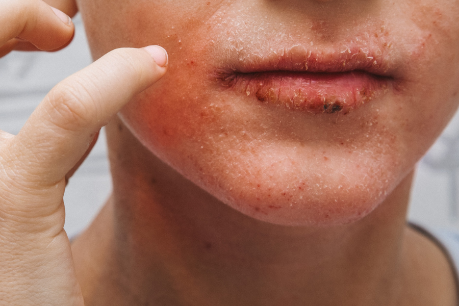 Topical Antibiotics vs Oral Antibiotics: What’s the Difference and What Does It Mean for Long Term Healing? | 184