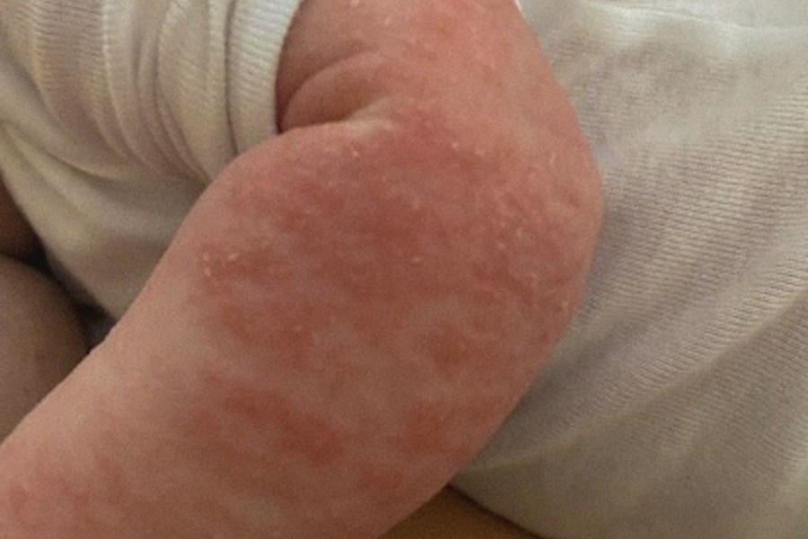 It’s Not Just Eczema - It’s a Cry for Help | 155
