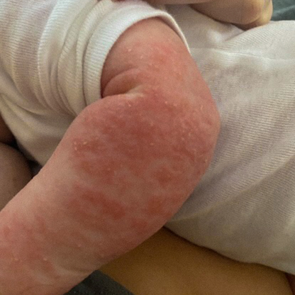 Eczema Healing Bundle