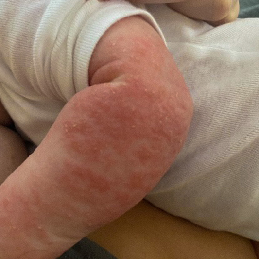 Eczema Healing Bundle