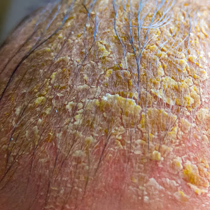 Scalp Healing Bundle